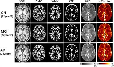 Application of High-Frequency Conductivity Map Using MRI to Evaluate It in the Brain of Alzheimer's Disease Patients